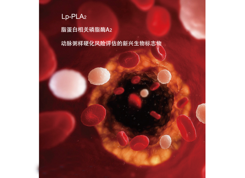 Lp-PLA2----動脈粥樣硬化斑塊穩(wěn)定性的評估標(biāo)志物